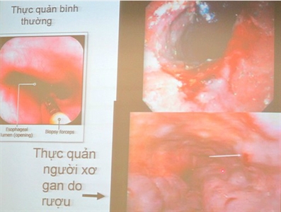 Báo động nhiều người mắc ung thư, teo não vì uống rượu