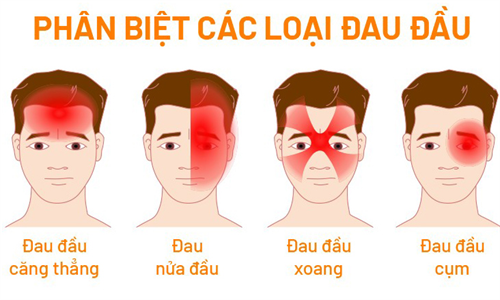 Đau đầu - dấu hiệu của nhiều loại bệnh